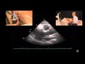 Measuring the Ascending Aorta Using Echocardiography