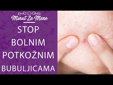 Video: Pomažu li kapi za oči kod crvenila bubuljica?