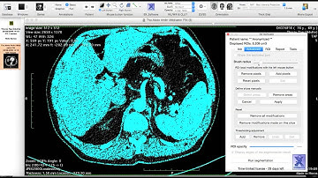 Exemple n°1 Segmentation kidney