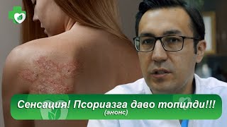 Сенсация! Псориазга даво топилди!!! (aнонс)