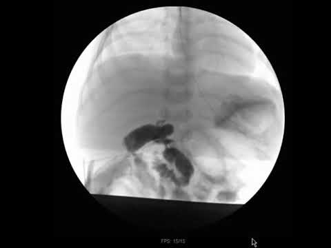Intraoperative Cholangiogram for Biliary Atresia - YouTube