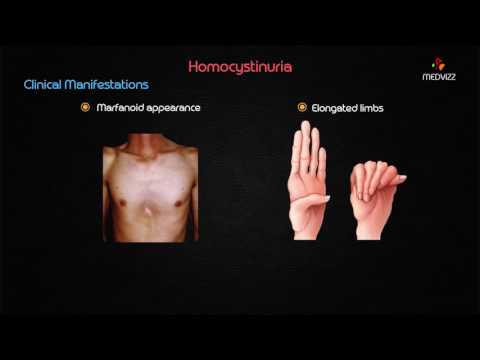 Homocystinuria - Usmle step 1 biochemistry Webinar based lecture