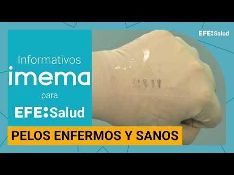 Informativo IMEMA: "Folículos pilosos enfermos y sanos"