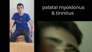 PALATAL MYOCLONUS ( Palatal tremor)