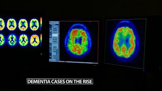 New study finds dementia cases on the rise