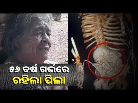 ୫୬ ବର୍ଷ ଧରି ମହିଳାଙ୍କ ପେଟରେ ଥିଲା ମୃତ ଛୁଆ । ଯେବେ ବାହାର କରାଗଲା