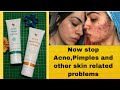 Now stops acnepimplesscars and other skin problems forever aloe propolis cream  aloe gelly