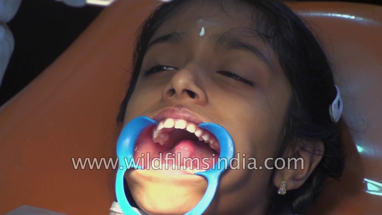 How braces are set into the mouth YouTube