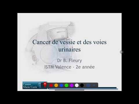 Vidéo: Carcinome à Cellules Rénales Métachrones Avec Métastases à La Vessie Et Aux Organes Distants, 28 Ans Après Une Néphrectomie Radicale: à Propos D'un Cas