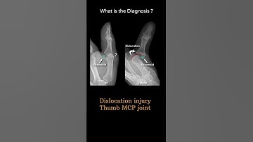 Dislocation injury Thumb MCP joint 149 X-ray Upper limb gallery 2 #@radiologychannel007