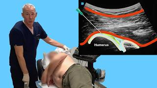 Shoulder Glenohumeral Joint Injection of HA with Ultrasound - Scanning Injection Training Video screenshot 2