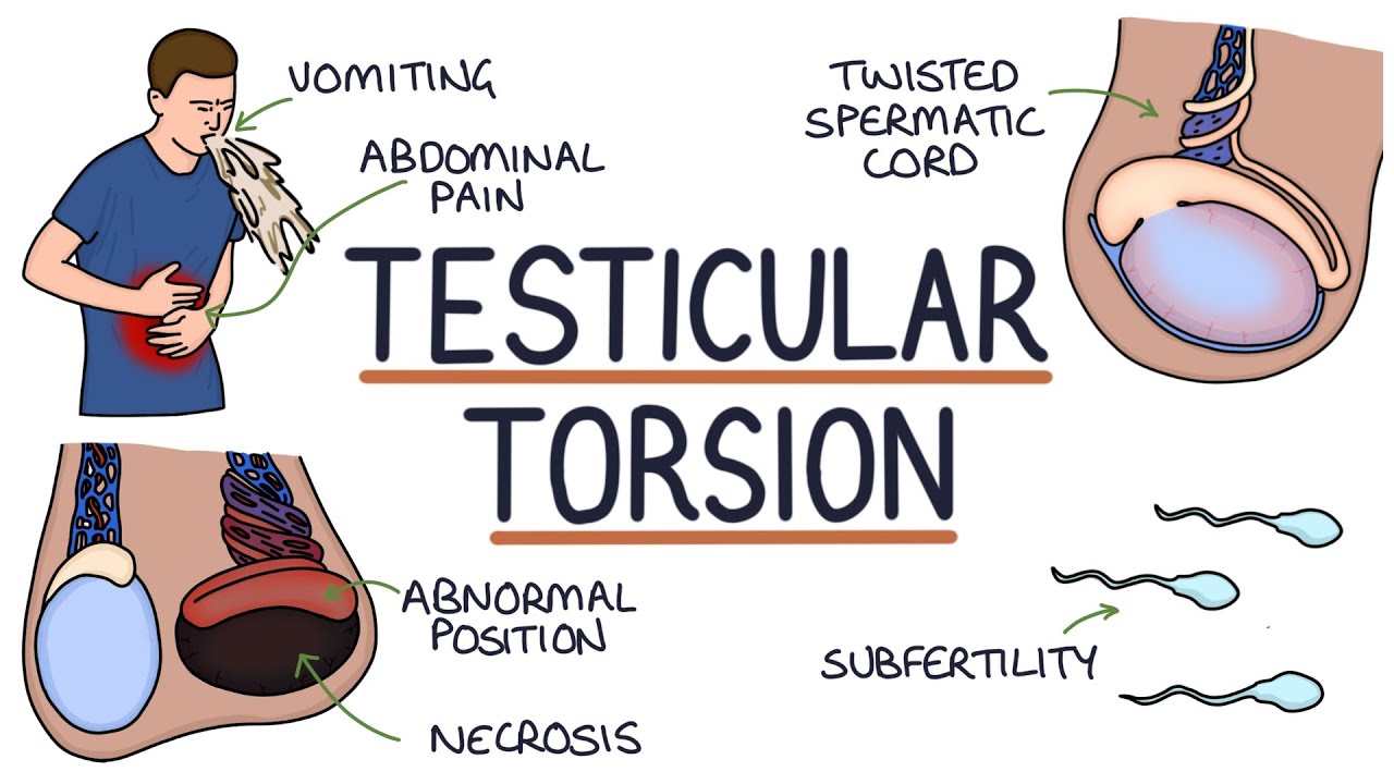 Understanding Testicular Torsion - YouTube