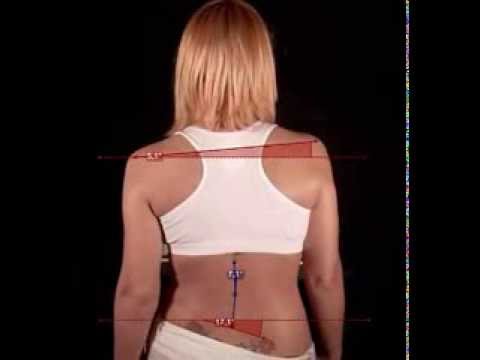 Analisis escoliosis con Kinovea analisis de sensibilidad
