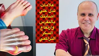 التهاب المفاصل والالم الرهـ.يب لمرضي السكر والنقرس هذه التغيرات في جلدك وجسمك.. تخبرك باصابتك بالسكر