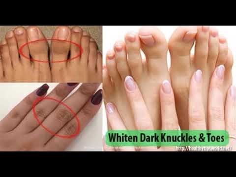 this-is-how-you-can-get-rid-of-dark-knuckles-and-toes-easily-at-home