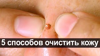 5 способов очистить кожу лица от Сальных пробок и избавиться от Прыщей и Угревой сыпи