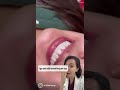 Why No Prep Veneers Are Ideal?!