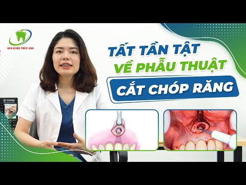 PHẪU THUẬT CẮT CHÓP RĂNG LÀ GÌ? Thủ thuật này có thể giúp bạn giữ lại chiếc răng thật.
