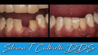 Mandibular Anterior Maryland Bridge - Dental Minute with Steven T. Cutbirth, DDS