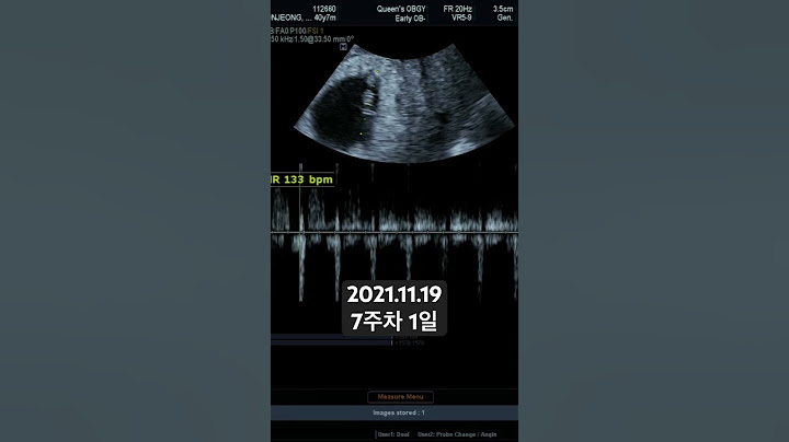 임신 7주차 1일 #임신기록 #초음파 #임신초음파