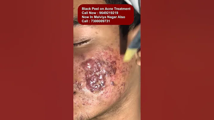 Best Black Peel on Acne Treatment at Skinaa Clinic | Viral #shorts
