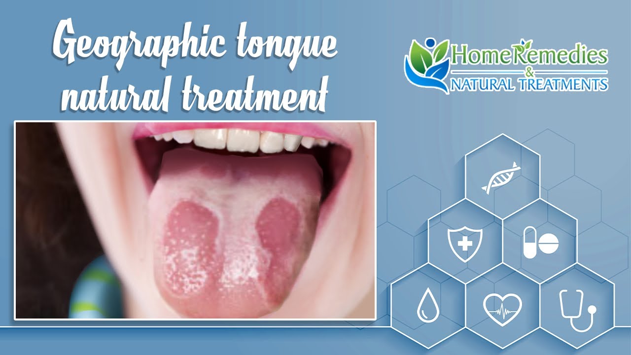 Home Remedies And Natural Treatments For Geographic Tongue Youtube