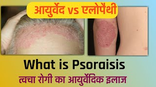 What Is Psoriasis Natural | treatment of PSORIASIS | सोरायसिस का आयुर्वेद इलाज #nehajoshi