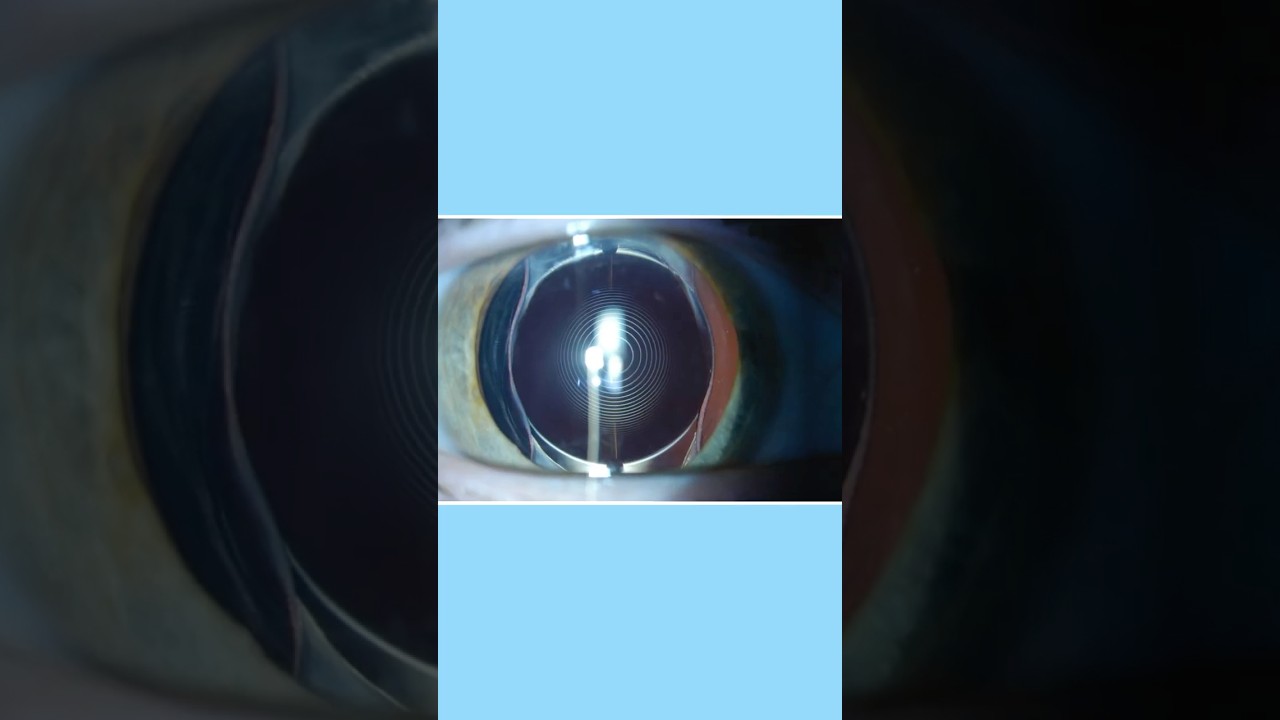 What are Edof lenses?