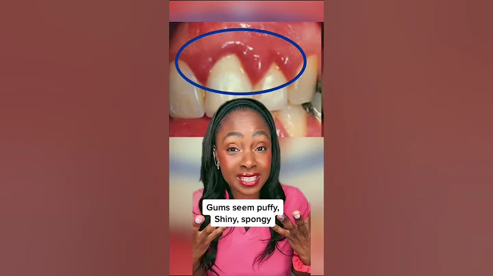 3 signs that YOU have gum disease #shorts #gumdisease #teeth