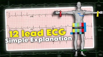 12 lead ECG | ECG interpretation made easy • Daily Cardiology