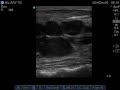 Case Challenge 99 Video 3. Fulminant anterior and posterior cervical lymphadenopathy.