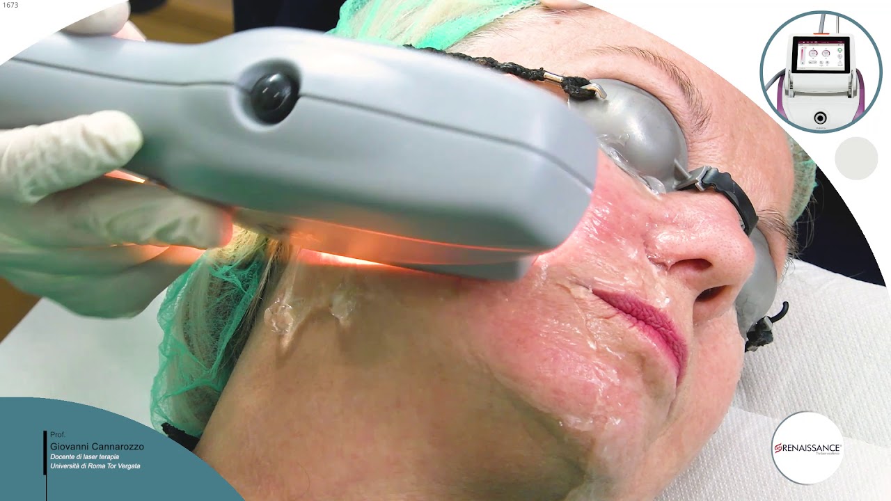 Luxea luce pulsata Lilac Fotoringiovanimento viso