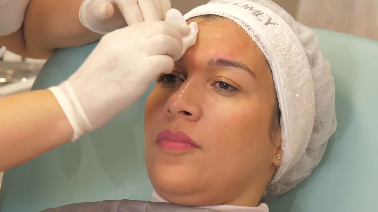 Toxine botulinique pour le haut du visage : technique