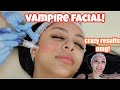 getting a vampire facial!