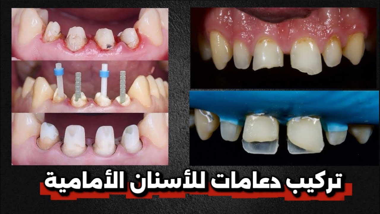 كيفية تركيب دعامة الاسنان post &core after RCT