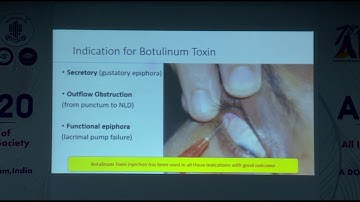 AIOC2020 IC294 T6 Dr Raj Anand Botulinum toxin for epiphora