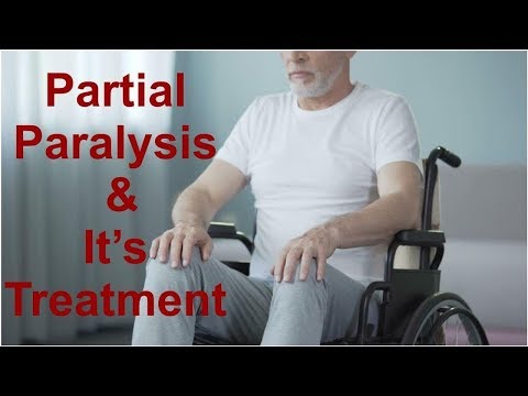 Hemiplegia: Causes and Treatments for Partial Paralysis | Tita TV