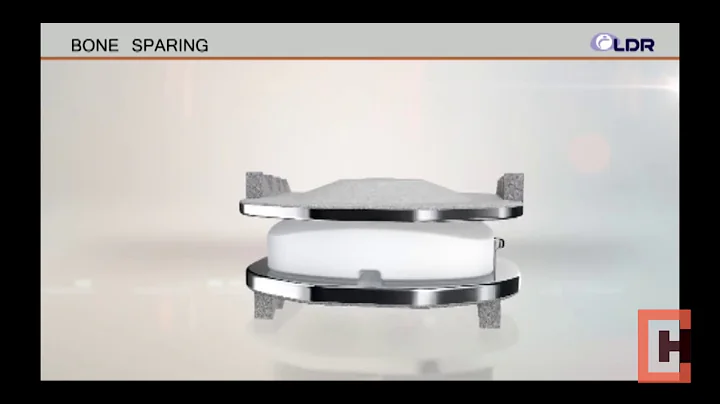 Cervical disc replacement - Dr Vito Loguidice