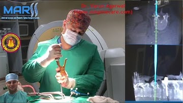OArm 3D navigation guided - Minimally Invasive Transforaminal Lumbar Interbody Fusion - MIS TLIF
