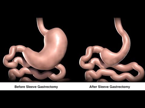 هل عملية قص المعدة لخسارة الوزن خطيرة؟ وما هي مضاعفاتها؟