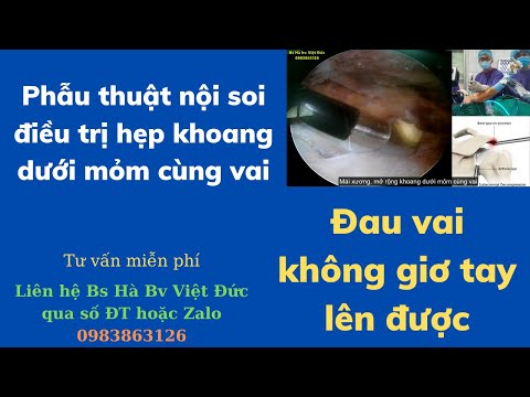 PHẪU THUẬT NỘI SOI ĐIỀU TRỊ ĐAU VAI DO HẸP KHOANG DƯỚI MỎM CÙNG VAI ( Subacromial decompression )