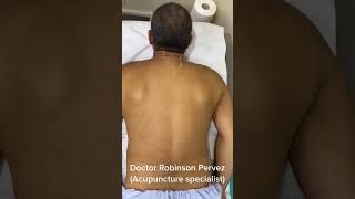 Acupuncture For Muscle Spasm. #acupuncture #acupuncturist #drrobinsonpervez#cervicalpain #backpain