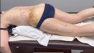 картинка: Острая боль в ноге. Миопрессура. Алгоритм лечения