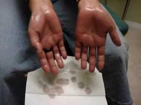 hyperhidrosis treatment