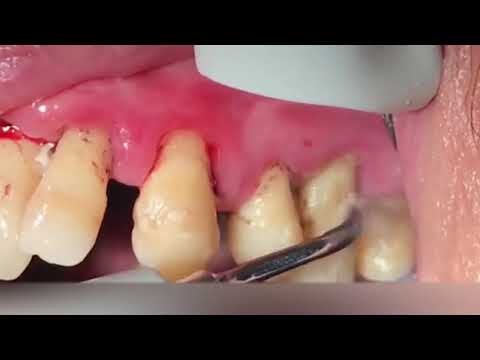 Удаление зубного камня скалером, ультразвуковая чистка зубо