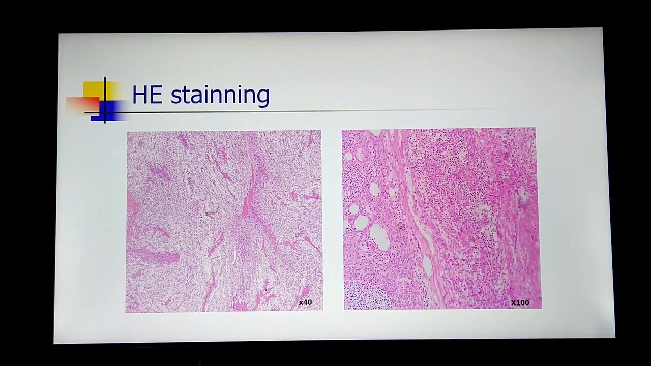 Papilloma stop krém. PapiSTOP vélemények, fórum, hozzászólások