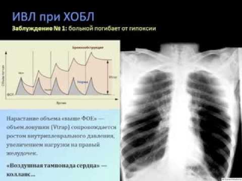 Респираторная поддержка при ХОБЛ (кИВЛ14дек) Кузьков В. В.