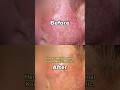 His Vitiligo Journey Ends Here: See the Fully Restored Skin. #Shorts
