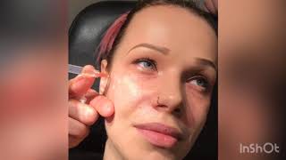 Midface Rejuvenation with Restylane Defyne | Dr. David P. Rapaport NYC