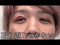 【整形】二重切開をした結果ダウンタイムがヤバすぎた